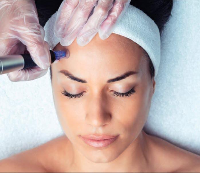 Microneedling